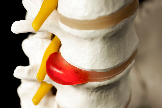 "Slipped disc. Spinal model demonstrating a slipped intervertebral disc. The slipped disc is the (red)